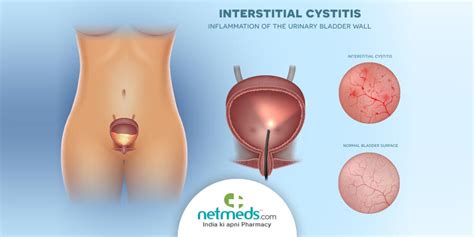 Interstitial Cystitis/Bladder Pain Syndrome: Causes, Symptoms And Treatment