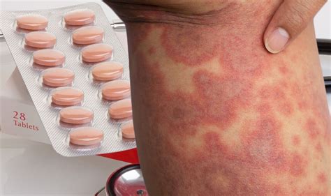 Statins: Side effects may include lichenoid dermatitis | Express.co.uk