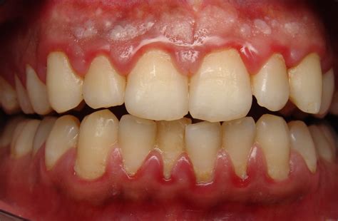 Gum disease? What is it? - Dental at Keys