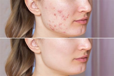 Acne before after Images - Search Images on Everypixel