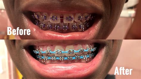 Braces Before And After Gap