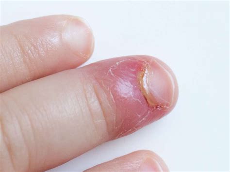 Paronychia is the medical term for an infection in the skin around the ...