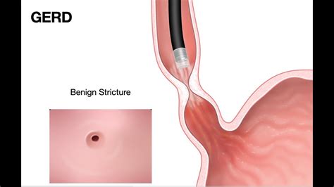 ECE-2e-Pathology of Esophagus-Esophageal stricture - YouTube