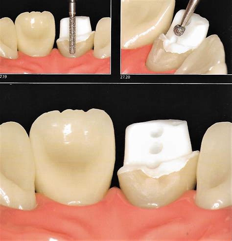 Anterior Crown Preparation | Dental Esthetics