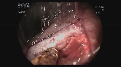 Bleeding Ulcer at Small Bowel Anastomosis - YouTube