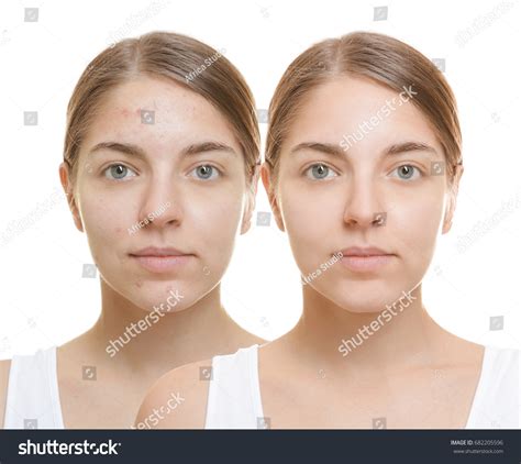 Young Woman Before After Acne Treatment Stock Photo 682205596 ...