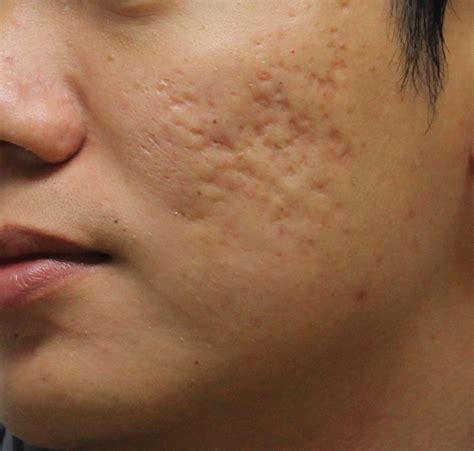 4 Easy Methods to Clear Up Acne Scars - BLOG De FASHION