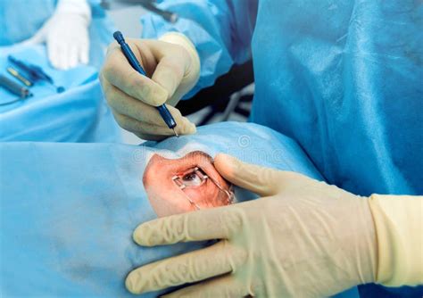 The Operation on the Eye. Cataract Surgery. Stock Photo - Image of ...