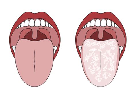 Treating an Oral Thrush Infection and Preventing Future Episodes ...