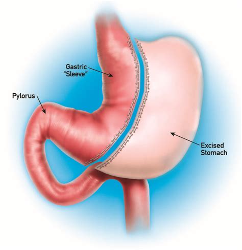 Sleeve Gastrectomy in Plano & Dallas, Laparoscopic Gastric Sleeve ...