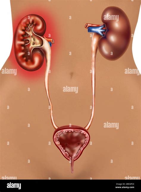 Pyelonephritis (Kidney Infection Stock Photo - Alamy