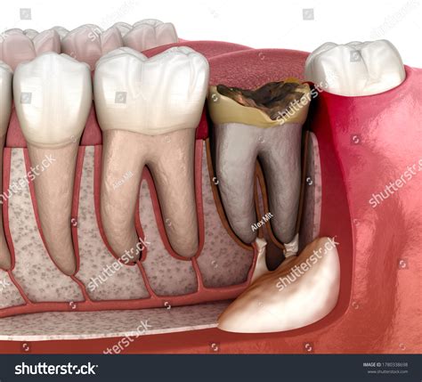 Diente de periostitis - Goma sobre: ilustración de stock 1780338698 ...