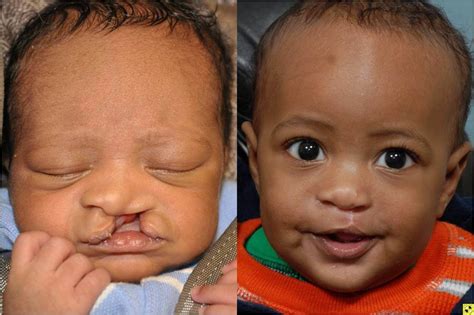 Cleft Lip Surgery Before And After