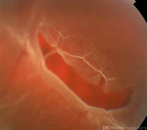 Retinal Tear at the Posterior Edge of Lattice Degeneration - Retina ...