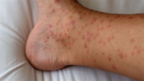 Can’t-Miss Takeaways Of Tips About How To Prevent Hives - Delaybeat