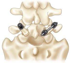 29: Spondylolysis Repair | Musculoskeletal Key