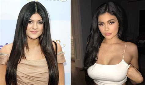 Kylie Jenner before and after surgery: boobs, teeth, lips [PHOTOS]