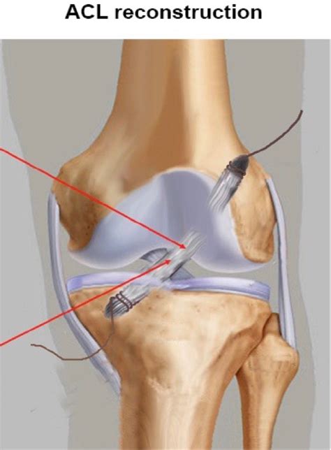 ACL Repair Surgery | Mahwah Valley Orthopedic Associates