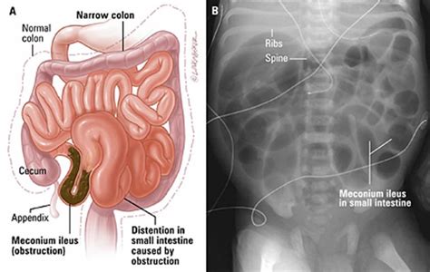 Meconium ileus causes, symptoms, diagnosis, treatment & prognosis