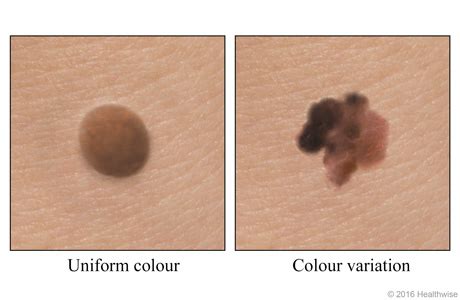 What does a cancerous mole look like? • Illuminate Skin Clinics