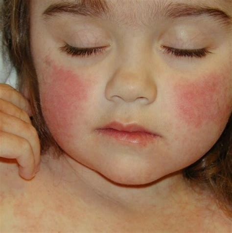 A Visual Guide To Viral Rashes Viral Rash Rash On Face Skin | Images ...