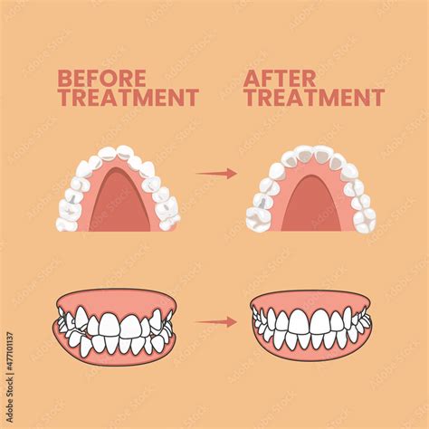 Teeth Before and After Treatment Vector Icon Illustration. Teeth Before ...