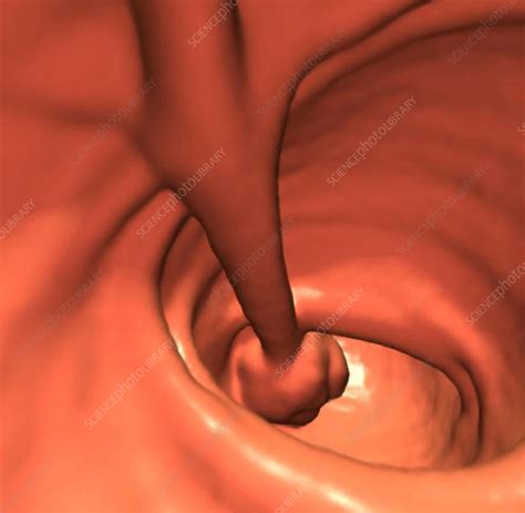 Colon polyp, CT scan - Stock Image - C023/4568 - Science Photo Library