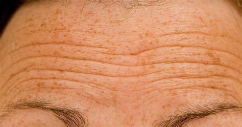 Why Men's Forehead Wrinkles Are Worse and How to Treat the Problem