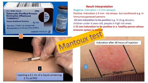 Positive Ppd Induration Size