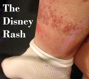 The Disney Rash - Description, prevention and treatment