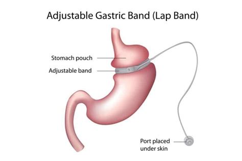 Lap Band Surgeon St Louis, MO | Laparoscopic Gastric Banding Surgery