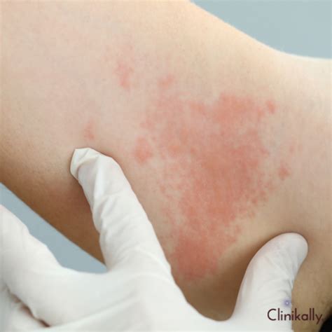 What are Welts (Skin Rash)? : Causes, Treatment, Home Remedies | Clinikally