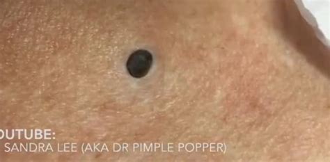 Dr. Pimple Popper -- The Biggest Blackhead In History!