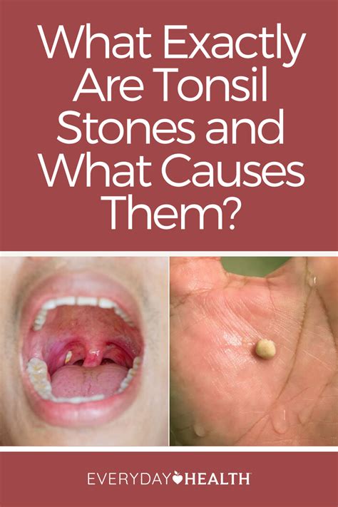 Learn what you need to know about tonsil stones. Health Risks, Health ...