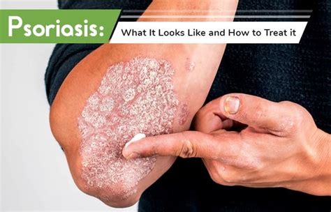 Psoriasis: What It Looks Like and How to Treat it | Winston Salem ...