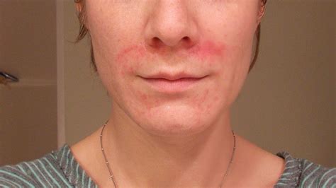 Eczema And Atopic Dermatitis Rashes Causes Symptoms