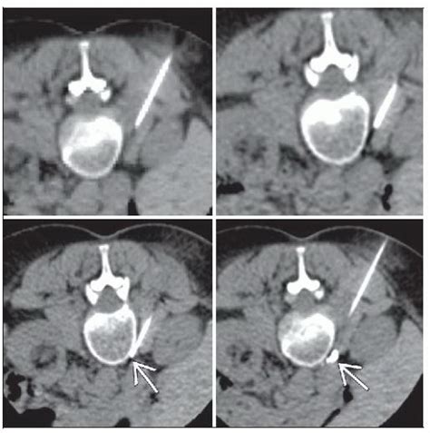 Celiac Plexus Block | Radiology Key