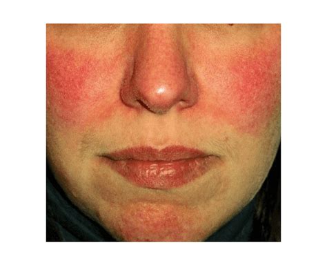 Common Skin Rashes In Adults Face | Images and Photos finder