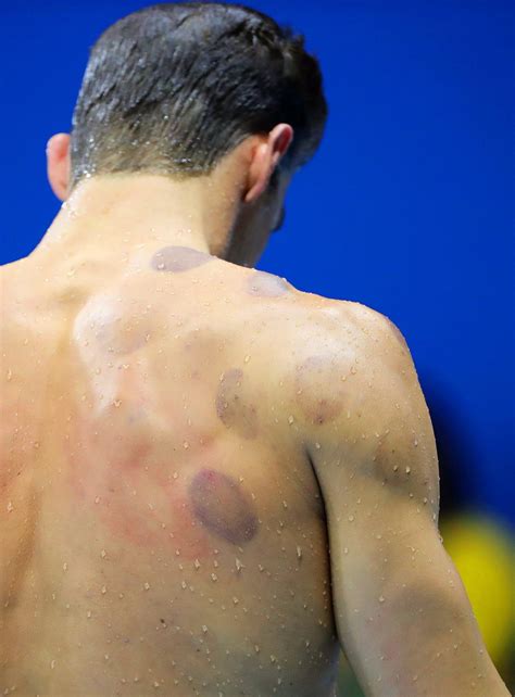 Rio Olympics 2016: What is Cupping Therapy and why is Michael Phelps ...