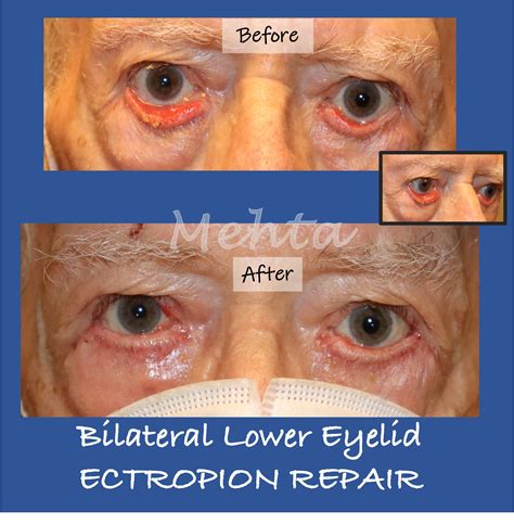 Entropion Surgery DC | Ectropion Repair Chevy Chase