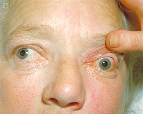 Exophthalmos (bulging eyes): what is it, symptoms and treatment | Top ...