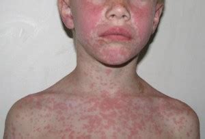 Amoxicillin Allergic Rash: Symptoms and Treatment | IYTmed.com