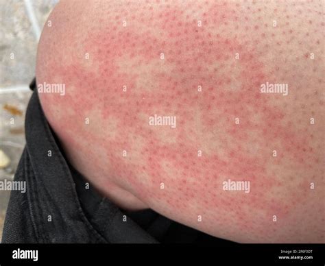 Mottled skin woman hi-res stock photography and images - Alamy