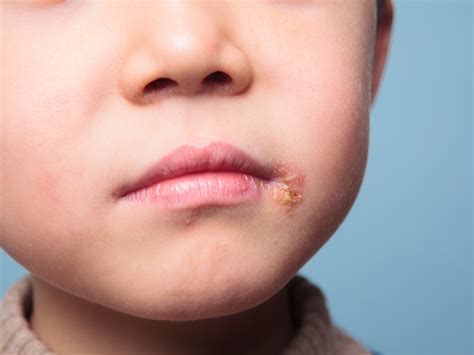 15 Common Skin Rashes In Children: Types And Causes, 52% OFF