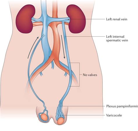 Varicocele Embolisation | Radiology.Wales