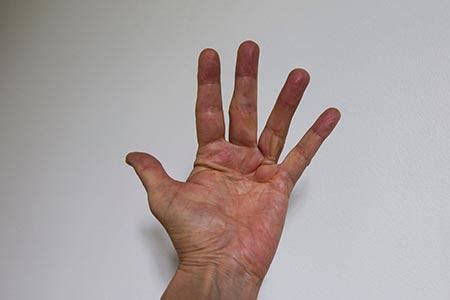 More About Lump in palm of hand - what should I do?