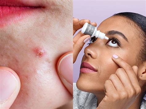 People love this viral hack for using eye drops to conceal acne — but a ...