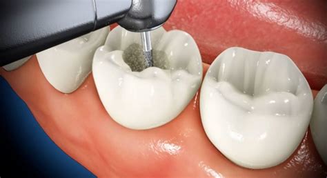 What is a Cavity Filling? - Keep 28 Dental