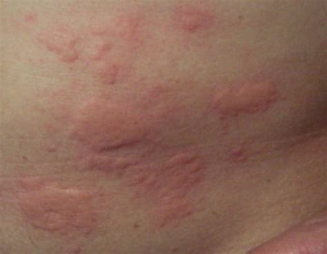 Roseola Rash | Good Health