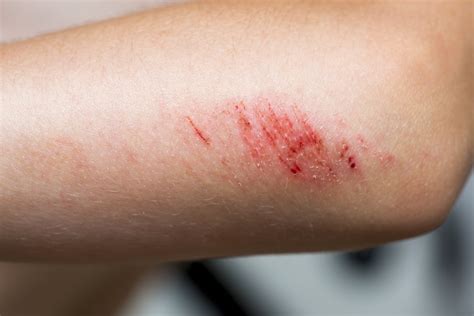 Treating Abrasions - Physicians Immediate Care